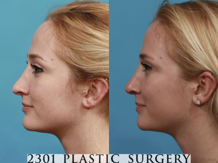 Before & After Rhinoplasty Case 483 View #3 View in Fort Worth, Plano, & Frisco, Texas