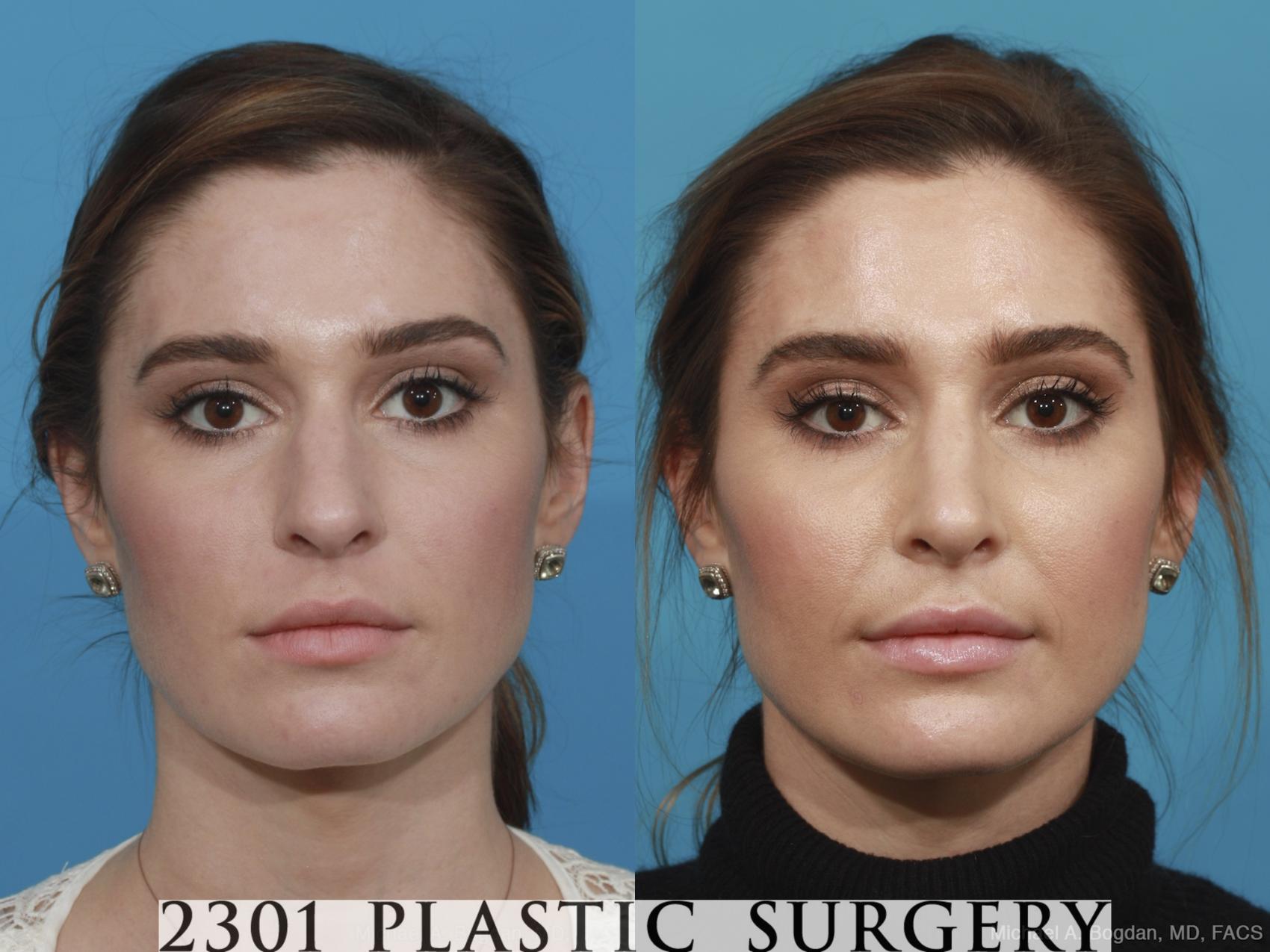 Before & After Rhinoplasty Case 490 View #1 View in Fort Worth & Frisco, Texas