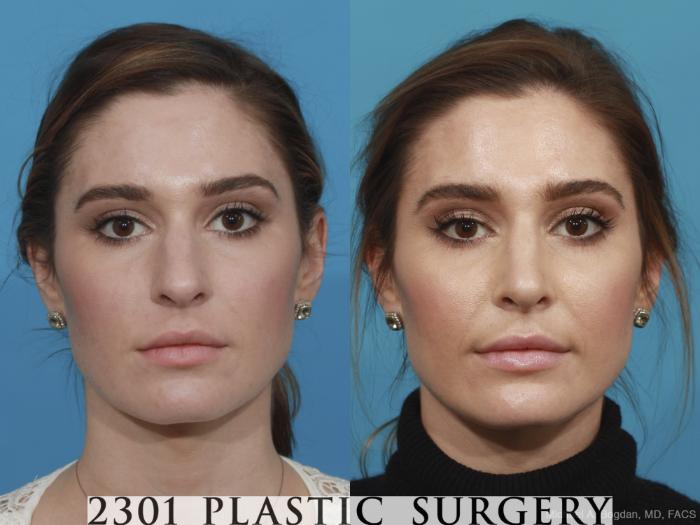 Before & After Rhinoplasty Case 490 View #1 View in Fort Worth, Plano, & Frisco, Texas