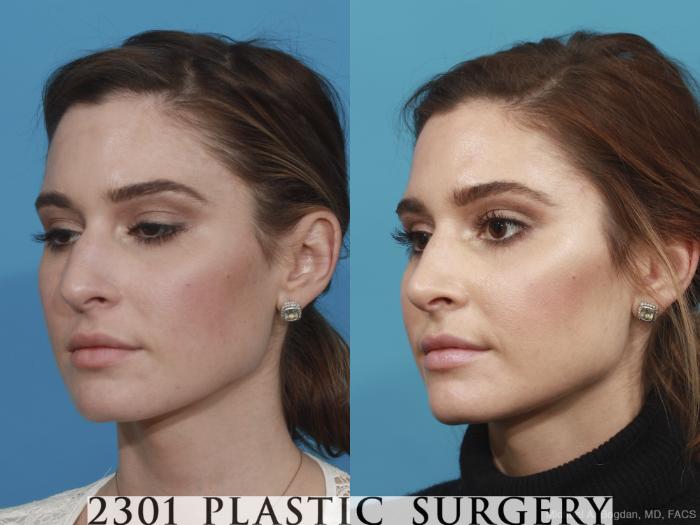 Before & After Rhinoplasty Case 490 View #2 View in Fort Worth, Plano, & Frisco, Texas