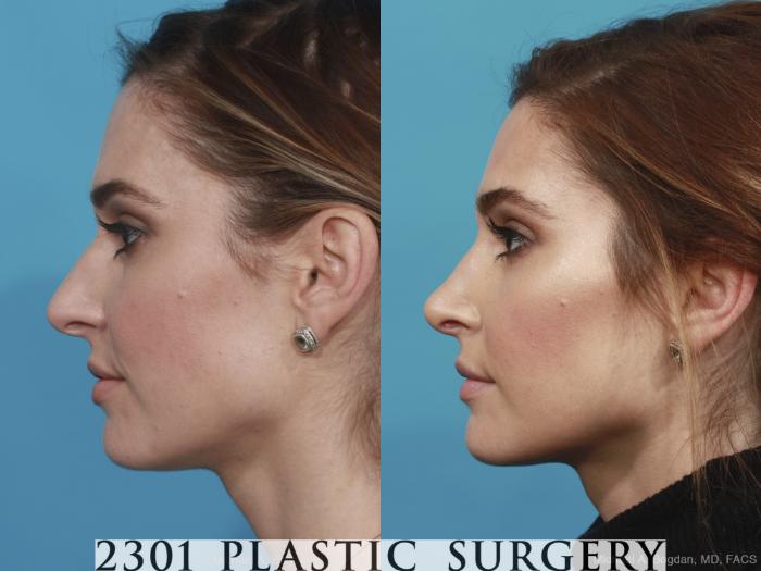 Before & After Rhinoplasty Case 490 View #3 View in Fort Worth, Plano, & Frisco, Texas