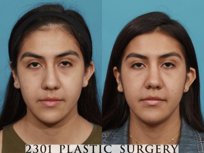 Before & After Rhinoplasty Case 520 View #1 View in Fort Worth, Plano, & Frisco, Texas