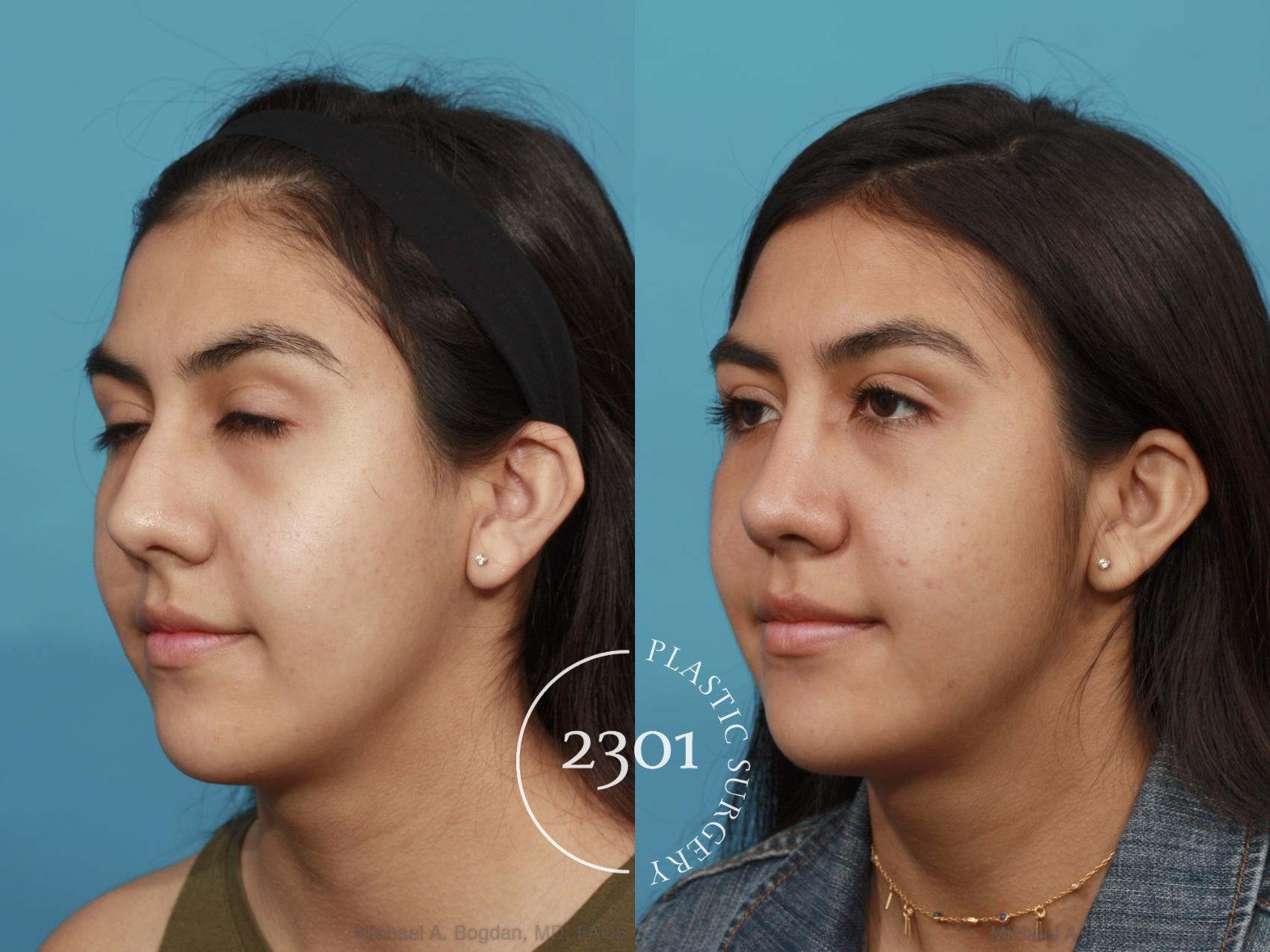 Before & After Rhinoplasty Case 520 View #2 View in Fort Worth, Plano, & Frisco, Texas