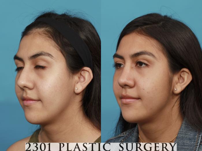 Before & After Rhinoplasty Case 520 View #2 View in Fort Worth, Plano, & Frisco, Texas