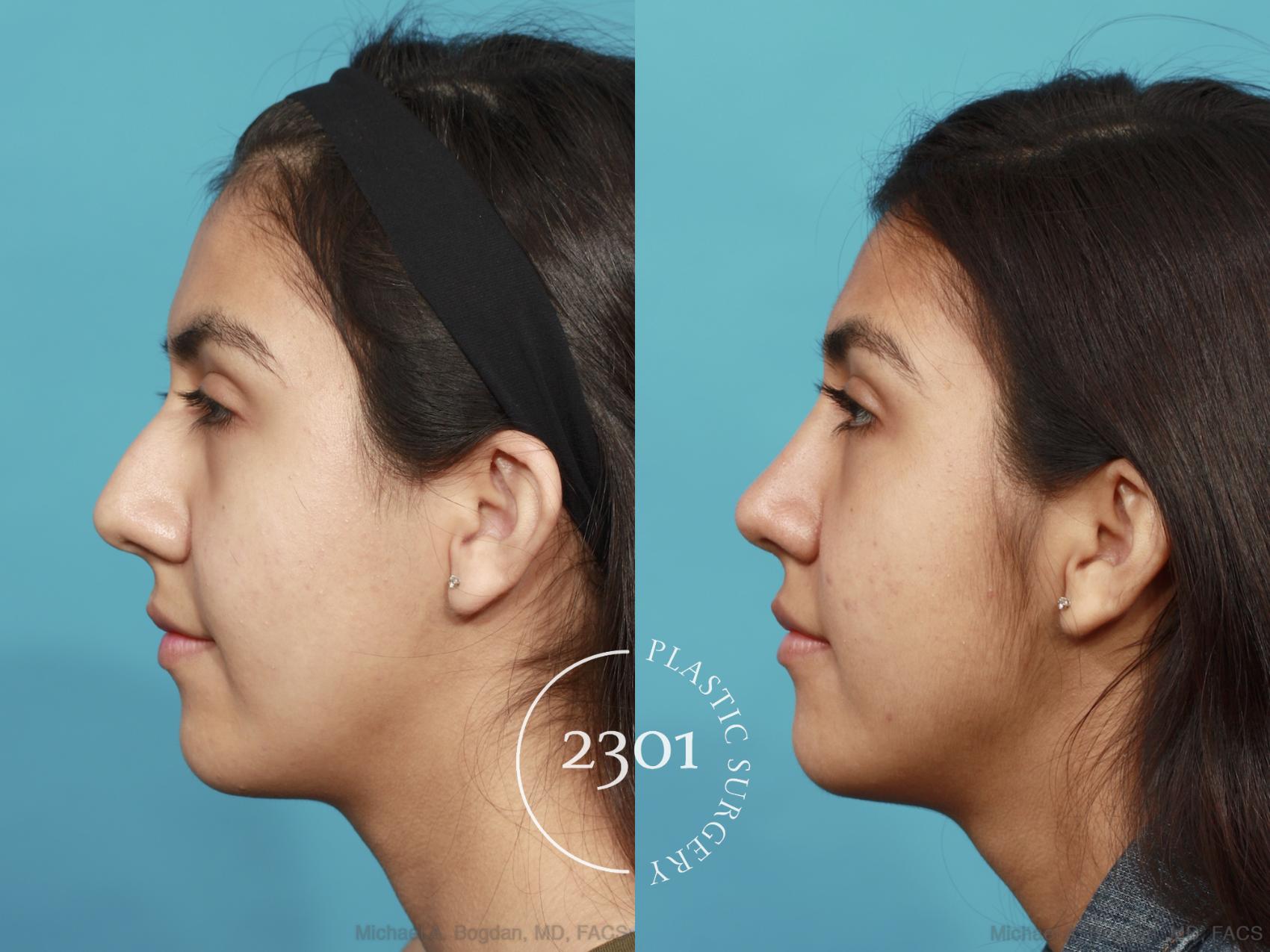 Before & After Rhinoplasty Case 520 View #3 View in Fort Worth, Plano, & Frisco, Texas