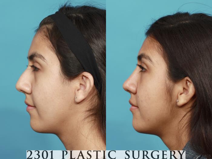 Before & After Rhinoplasty Case 520 View #3 View in Fort Worth, Plano, & Frisco, Texas