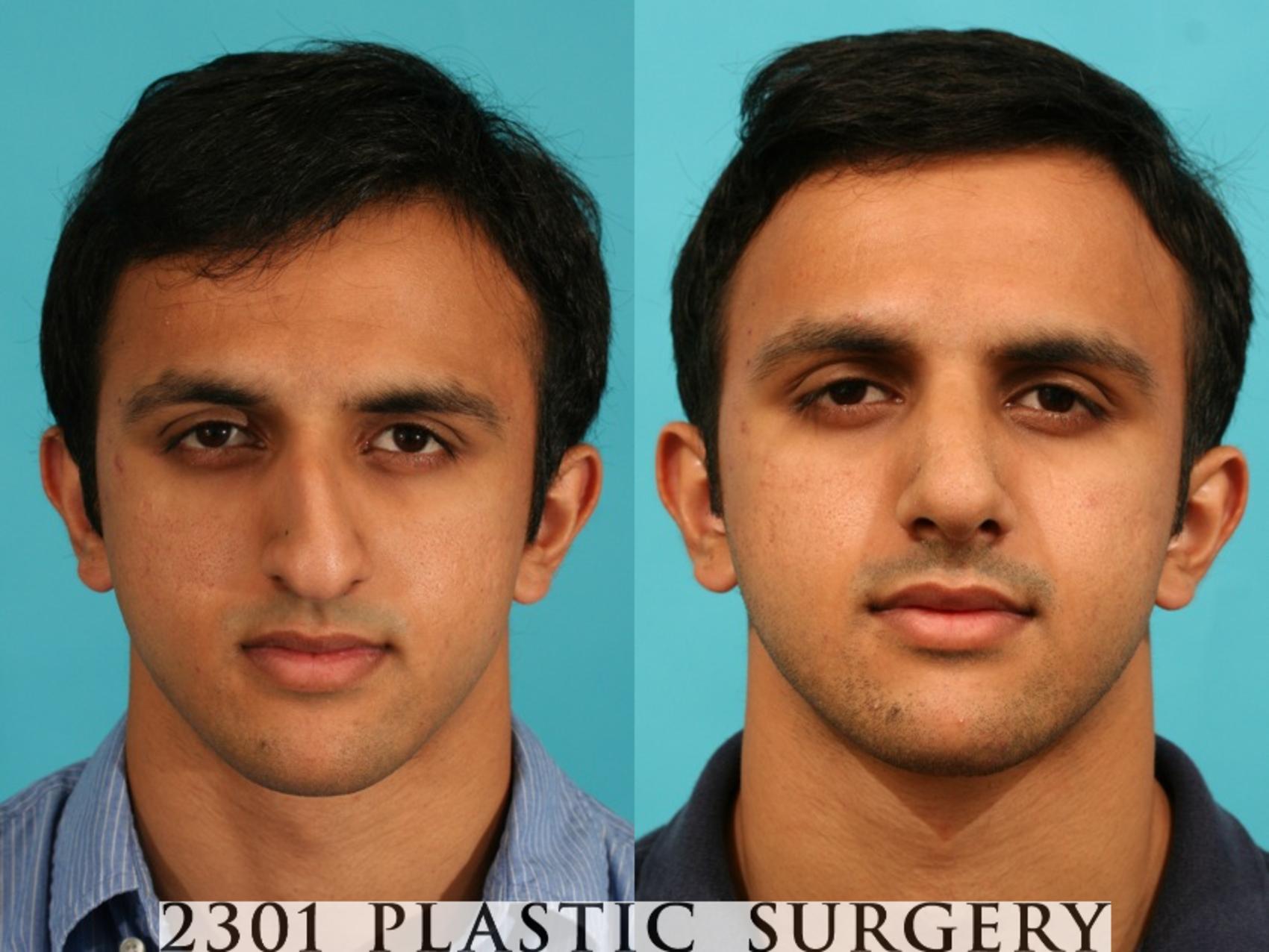 Before & After Rhinoplasty Case 53 View #1 View in Fort Worth, Plano, & Frisco, Texas