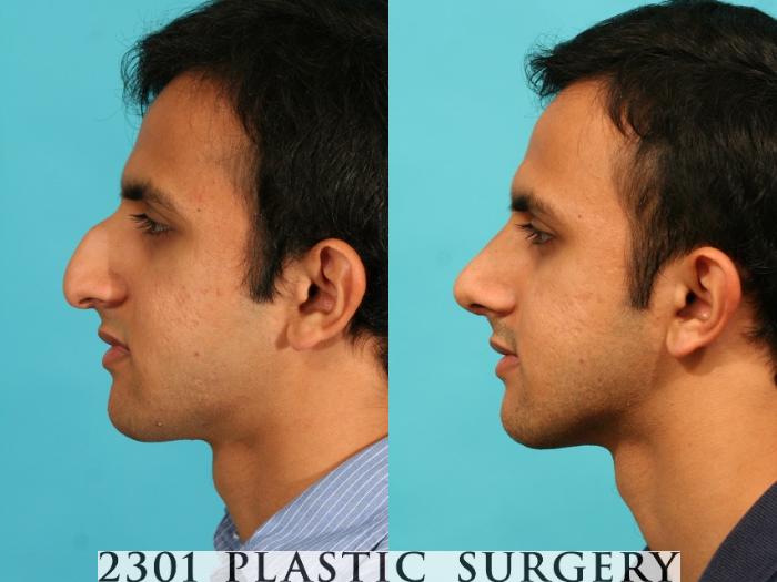Before & After Rhinoplasty Case 53 View #2 View in Fort Worth, Plano, & Frisco, Texas