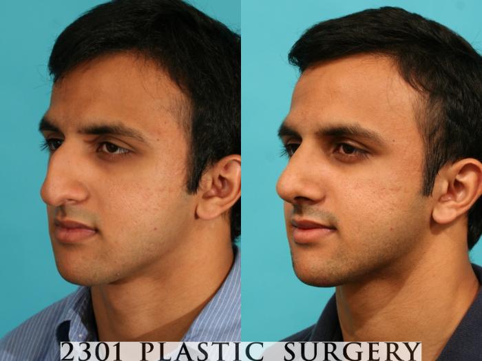 Before & After Male Rhinoplasty Case 53 View #3 View in Fort Worth, Plano, & Frisco, Texas