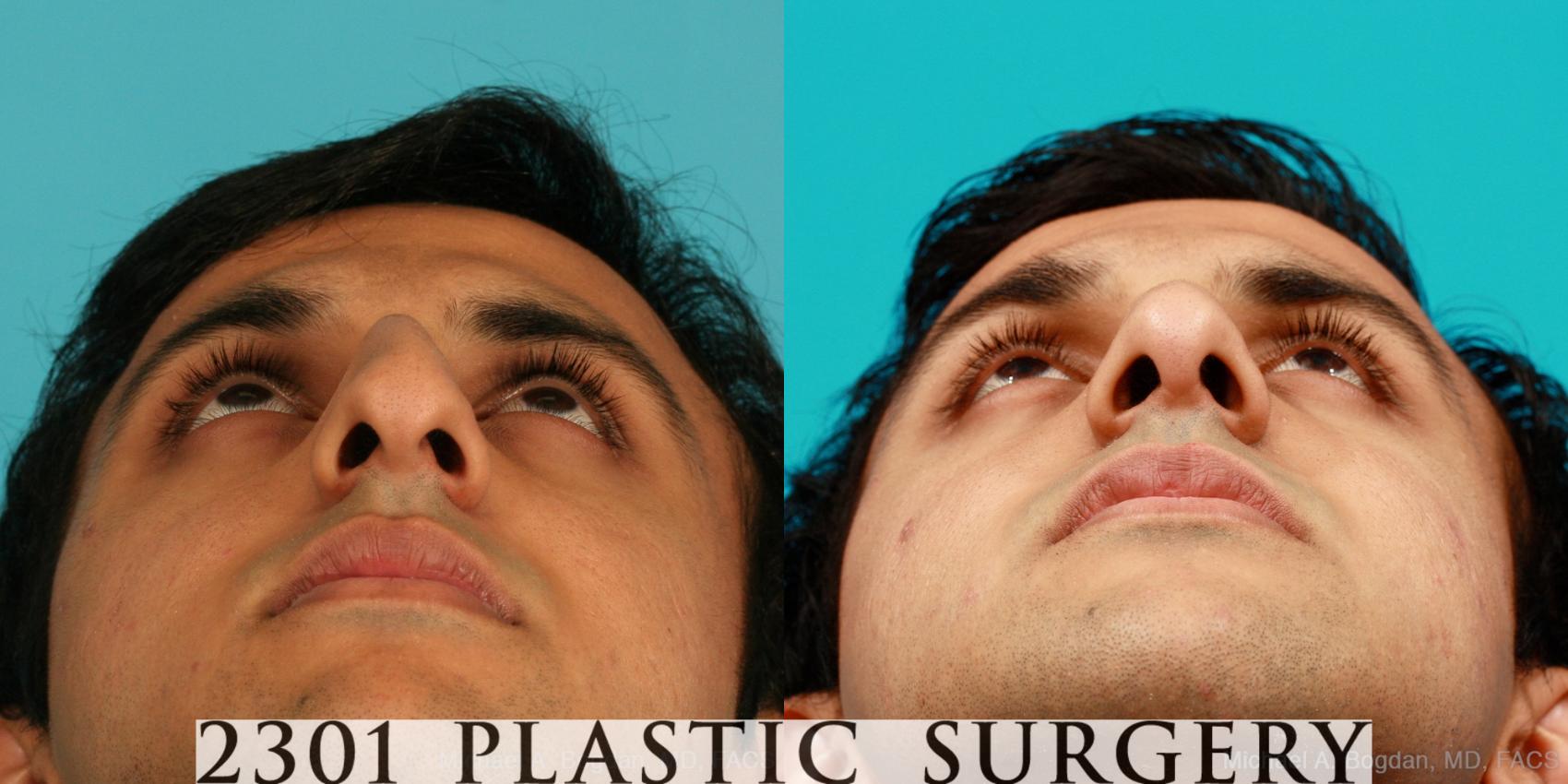 Before & After Rhinoplasty Case 53 View #4 View in Fort Worth & Frisco, Texas