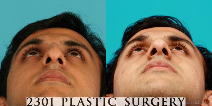 Before & After Male Rhinoplasty Case 53 View #4 View in Fort Worth, Plano, & Frisco, Texas