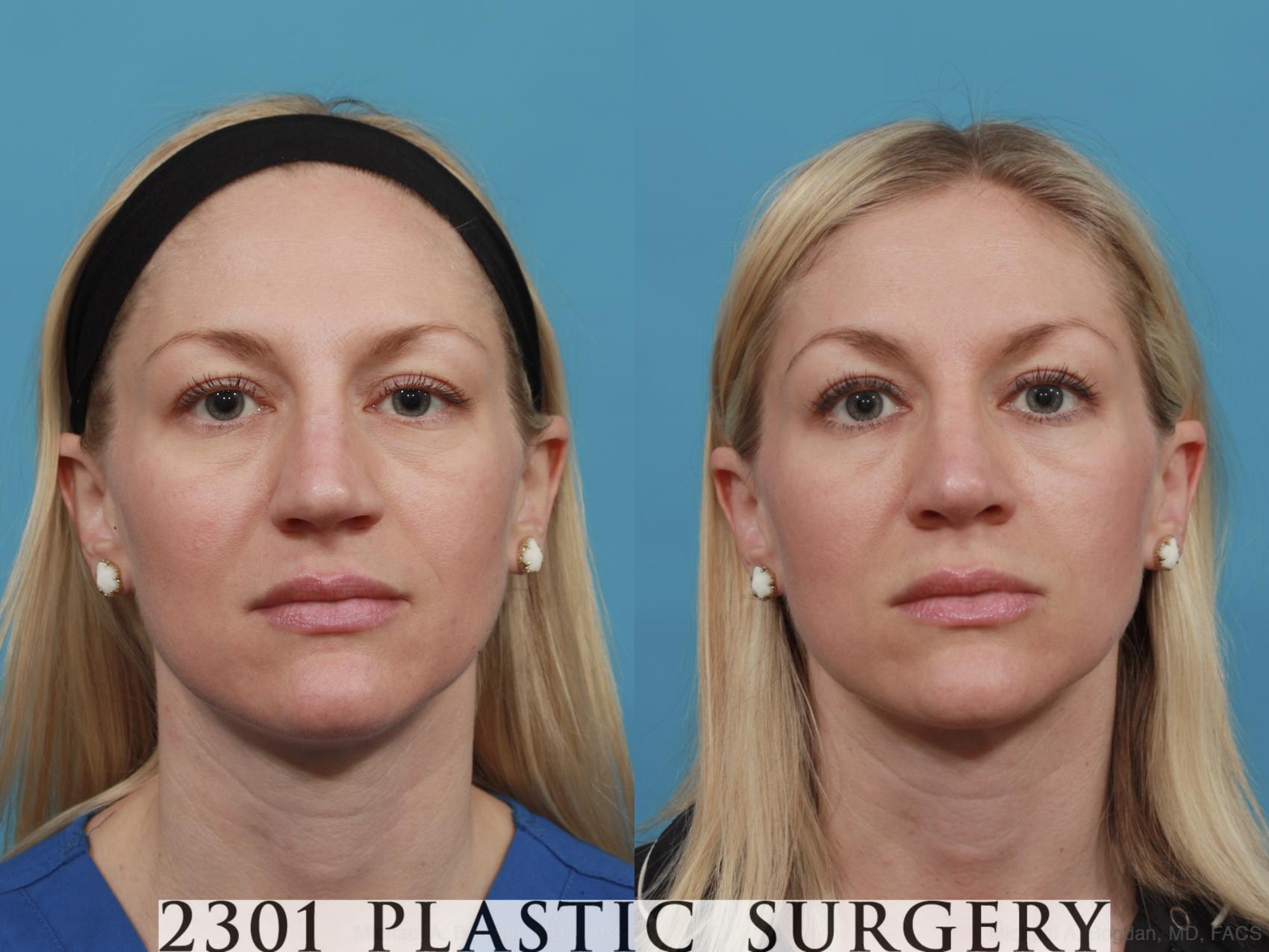 Before & After Rhinoplasty Case 556 View #1 View in Fort Worth & Frisco, Texas