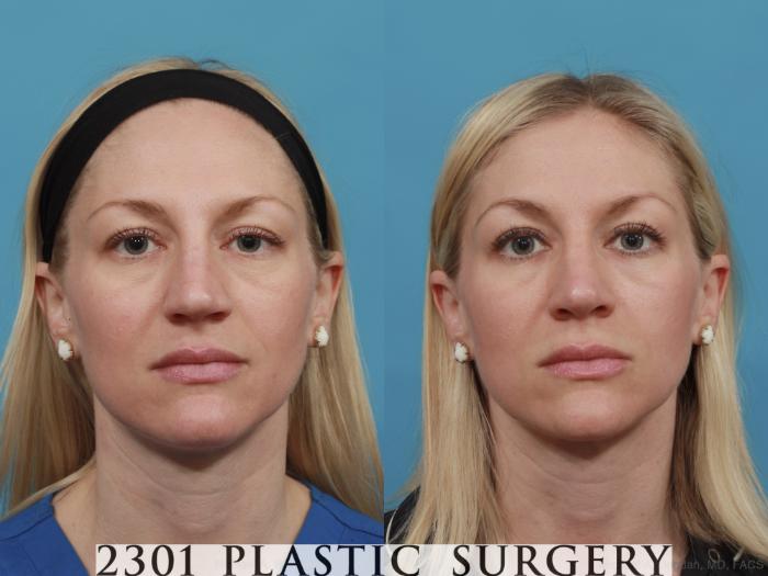 Before & After Rhinoplasty Case 556 View #1 View in Fort Worth, Plano, & Frisco, Texas