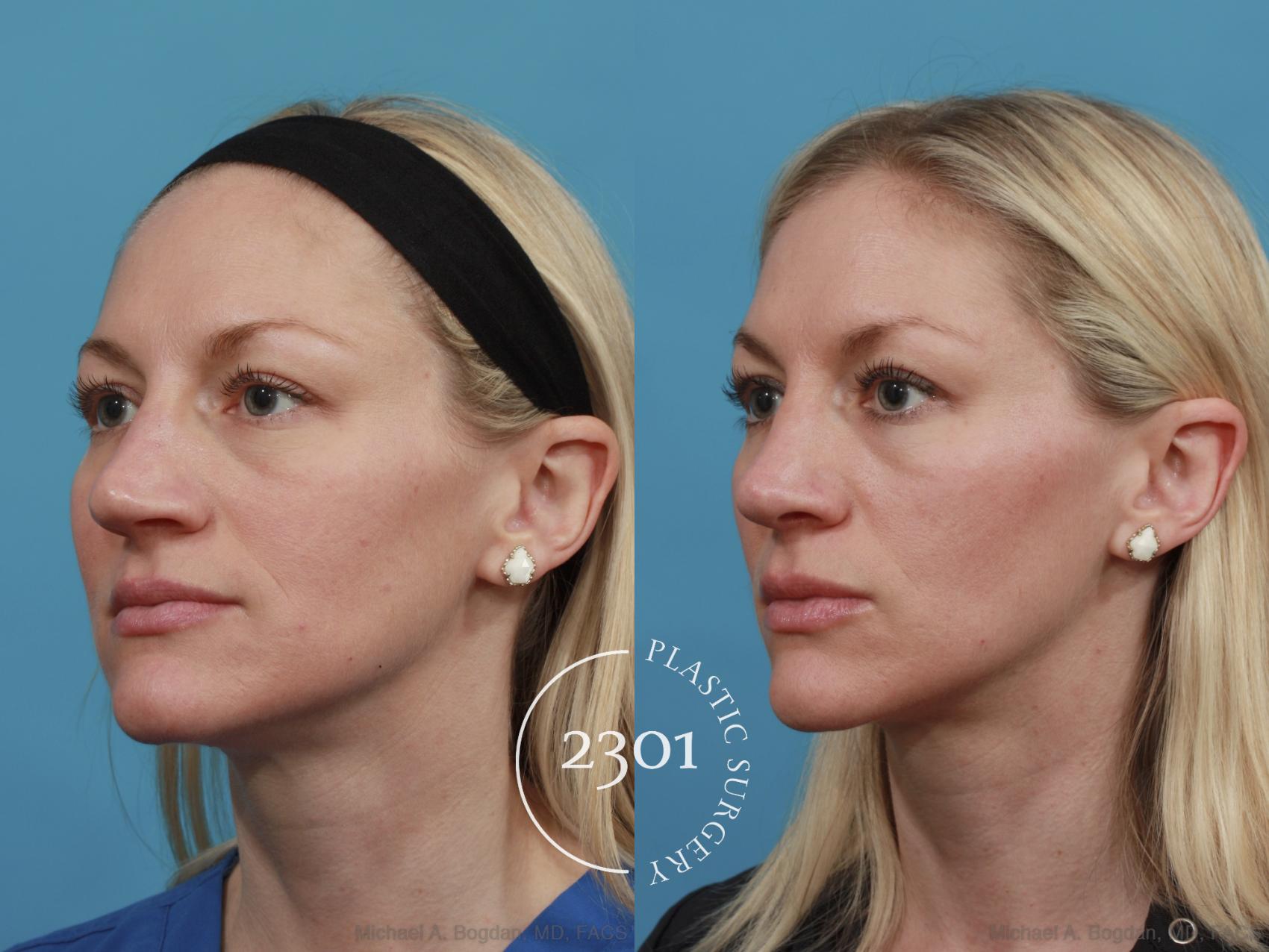 Before & After Rhinoplasty Case 556 View #2 View in Fort Worth, Plano, & Frisco, Texas