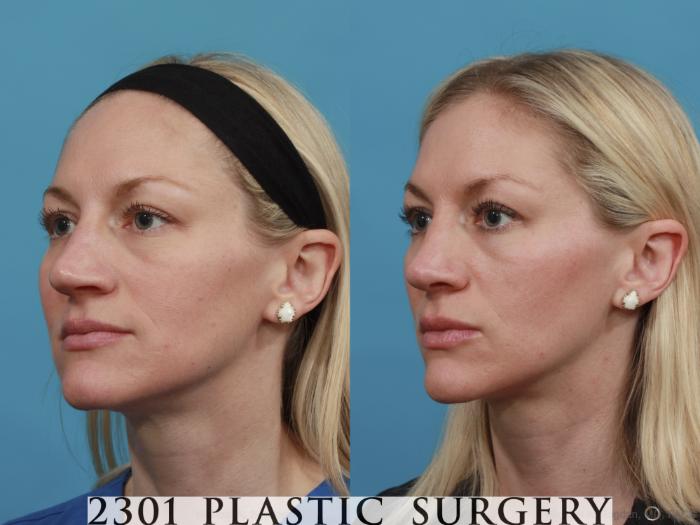 Before & After Rhinoplasty Case 556 View #2 View in Fort Worth, Plano, & Frisco, Texas