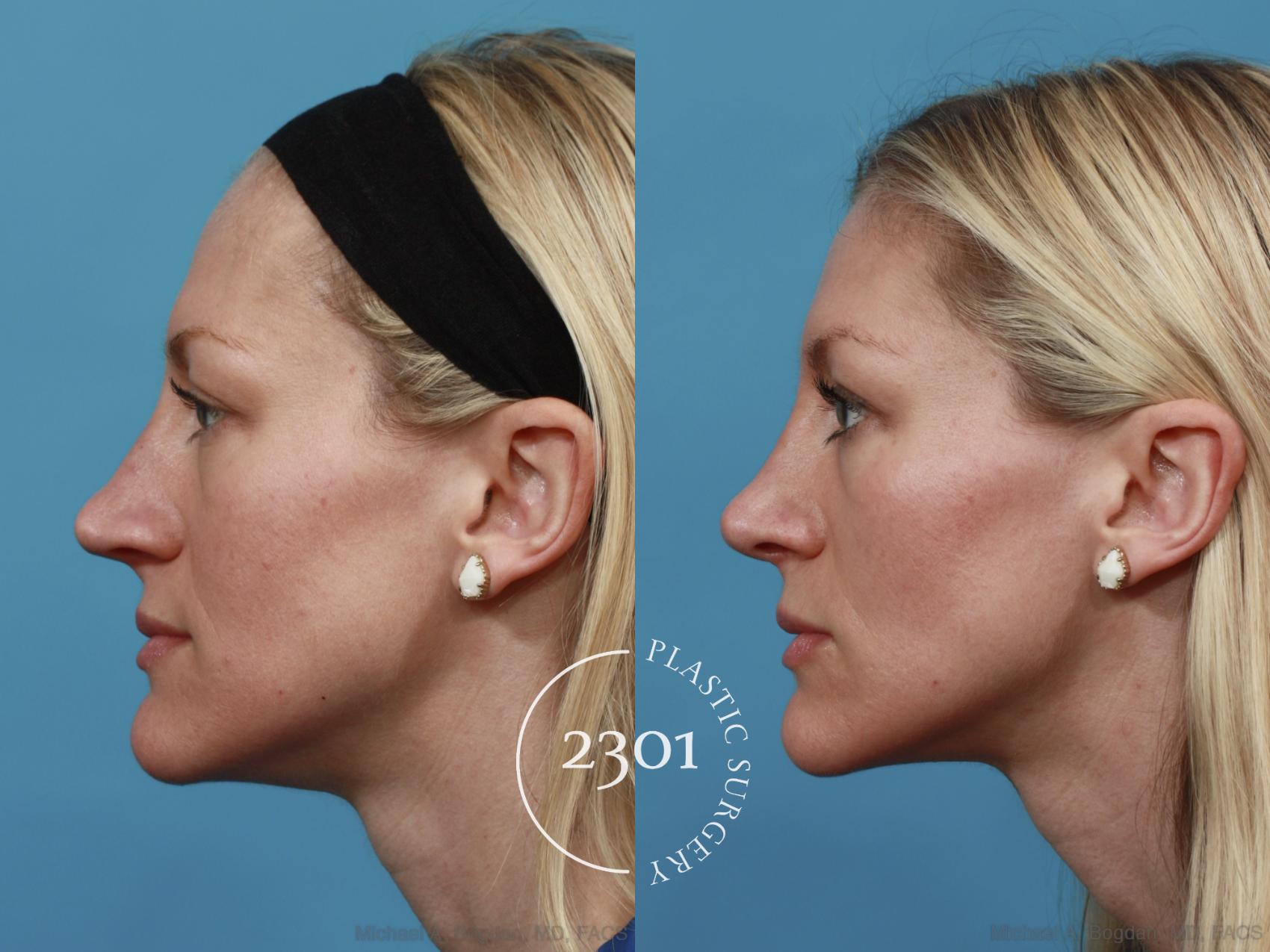 Before & After Rhinoplasty Case 556 View #3 View in Fort Worth, Plano, & Frisco, Texas