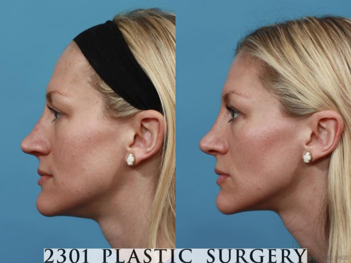 Before & After Rhinoplasty Case 556 View #3 View in Fort Worth, Plano, & Frisco, Texas