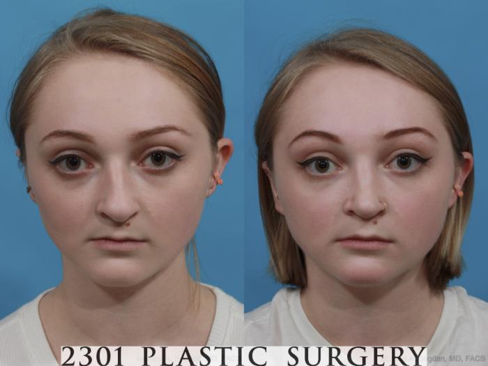 Before & After Rhinoplasty Case 571 View #1 View in Fort Worth & Frisco, Texas