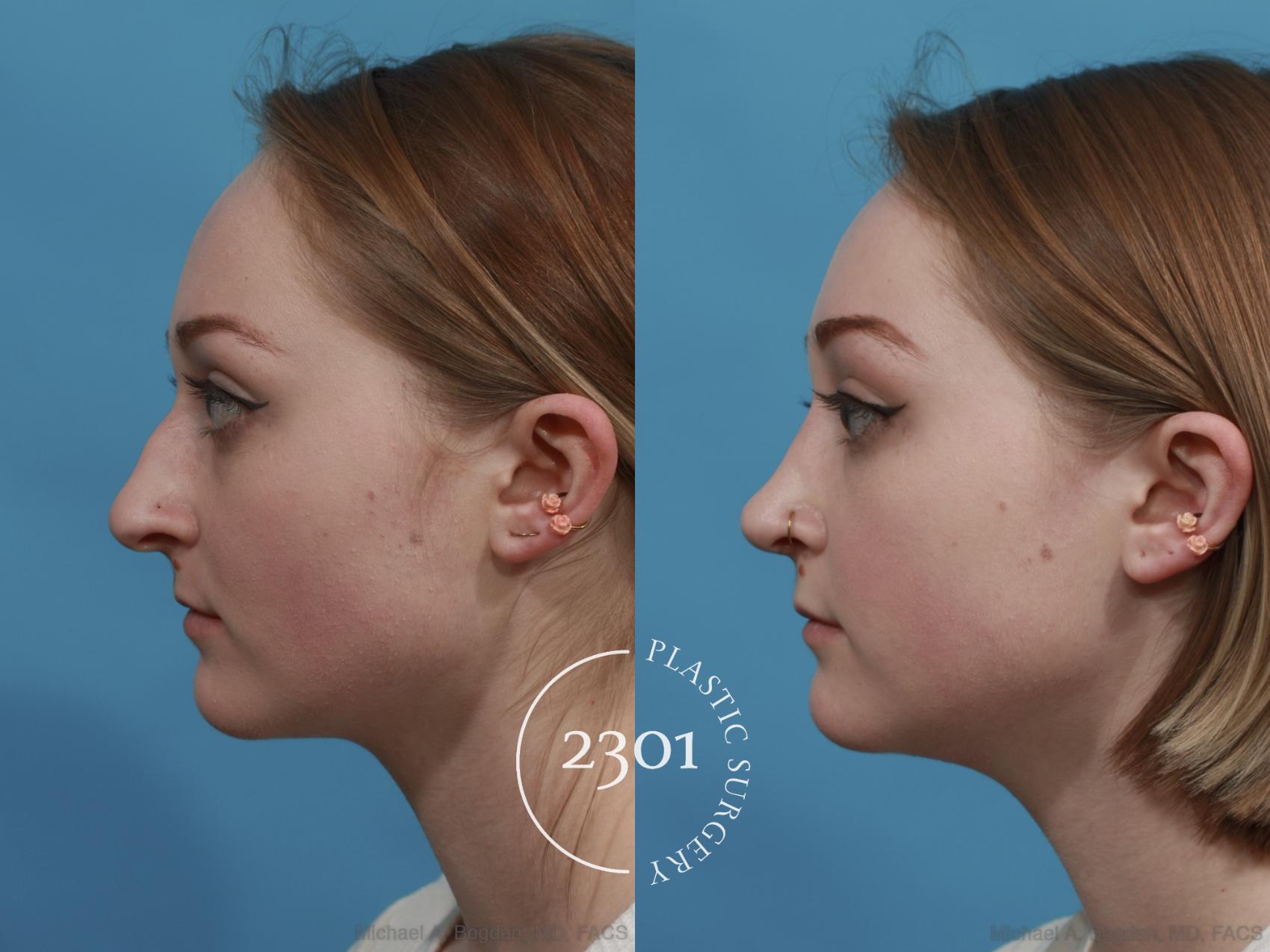 Before & After Rhinoplasty Case 571 View #2 View in Fort Worth, Plano, & Frisco, Texas