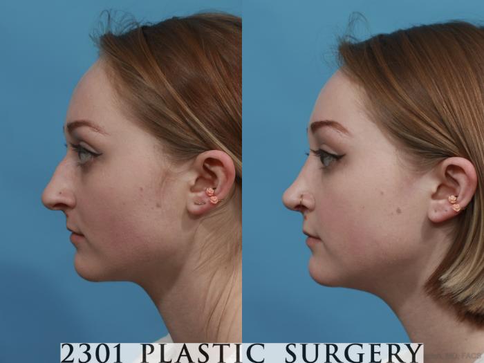 Before & After Rhinoplasty Case 571 View #2 View in Fort Worth, Plano, & Frisco, Texas