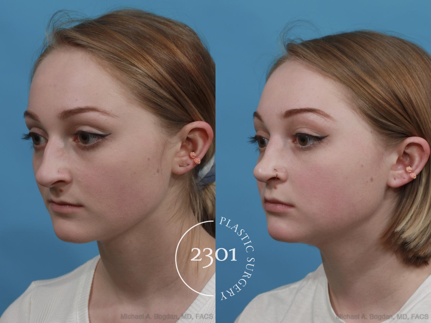 Before & After Rhinoplasty Case 571 View #3 View in Fort Worth, Plano, & Frisco, Texas