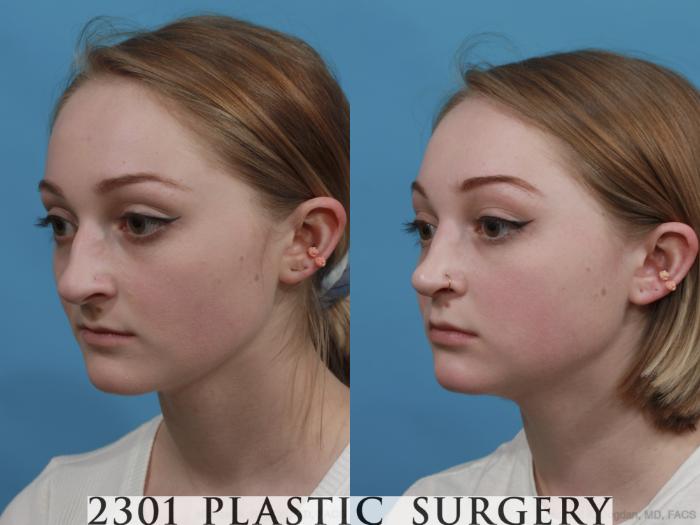 Before & After Rhinoplasty Case 571 View #3 View in Fort Worth, Plano, & Frisco, Texas