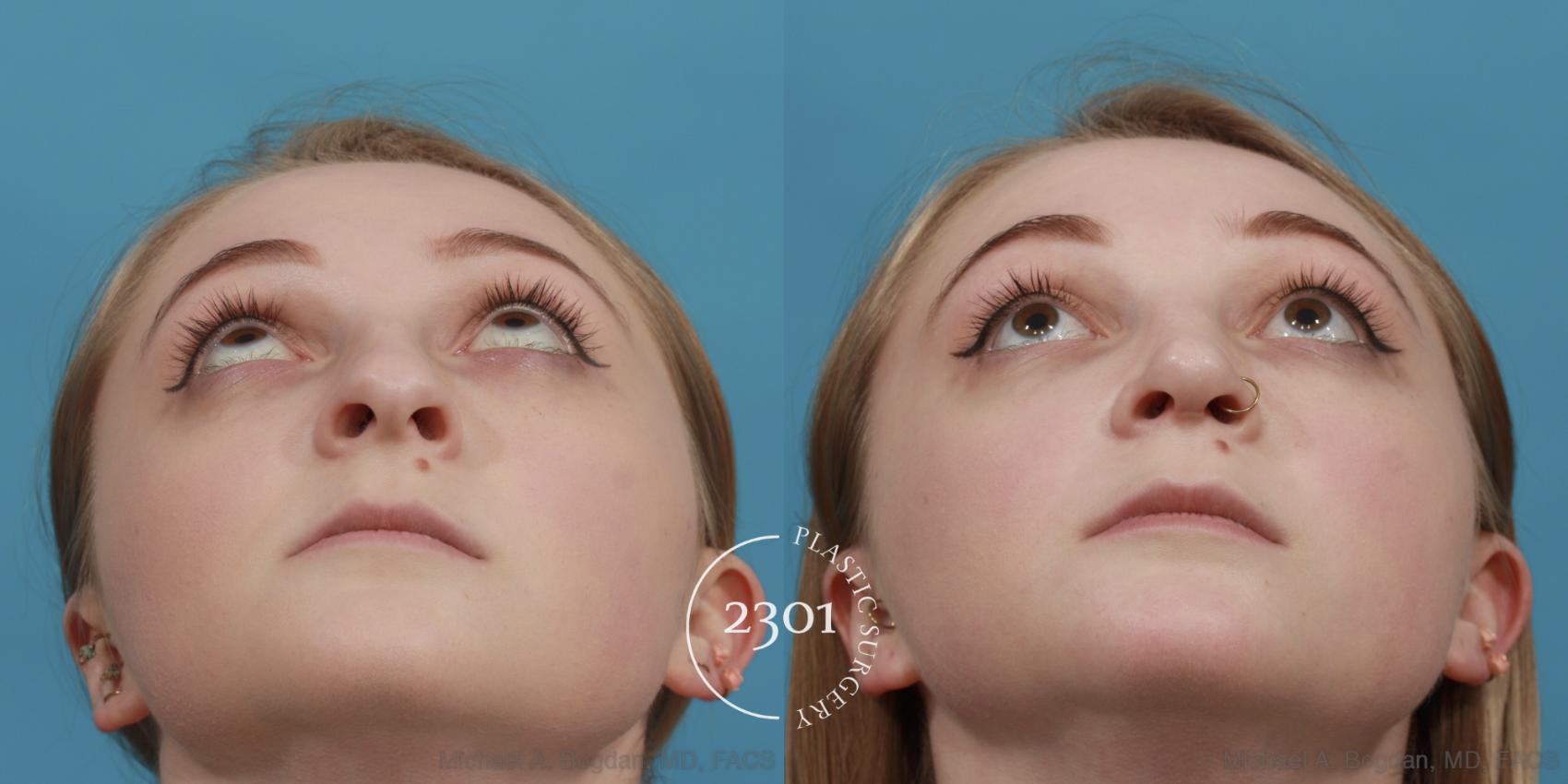 Before & After Rhinoplasty Case 571 View #4 View in Fort Worth, Plano, & Frisco, Texas