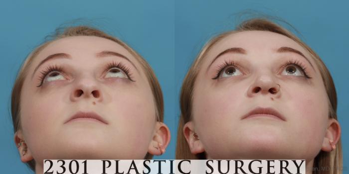 Before & After Rhinoplasty Case 571 View #4 View in Fort Worth, Plano, & Frisco, Texas