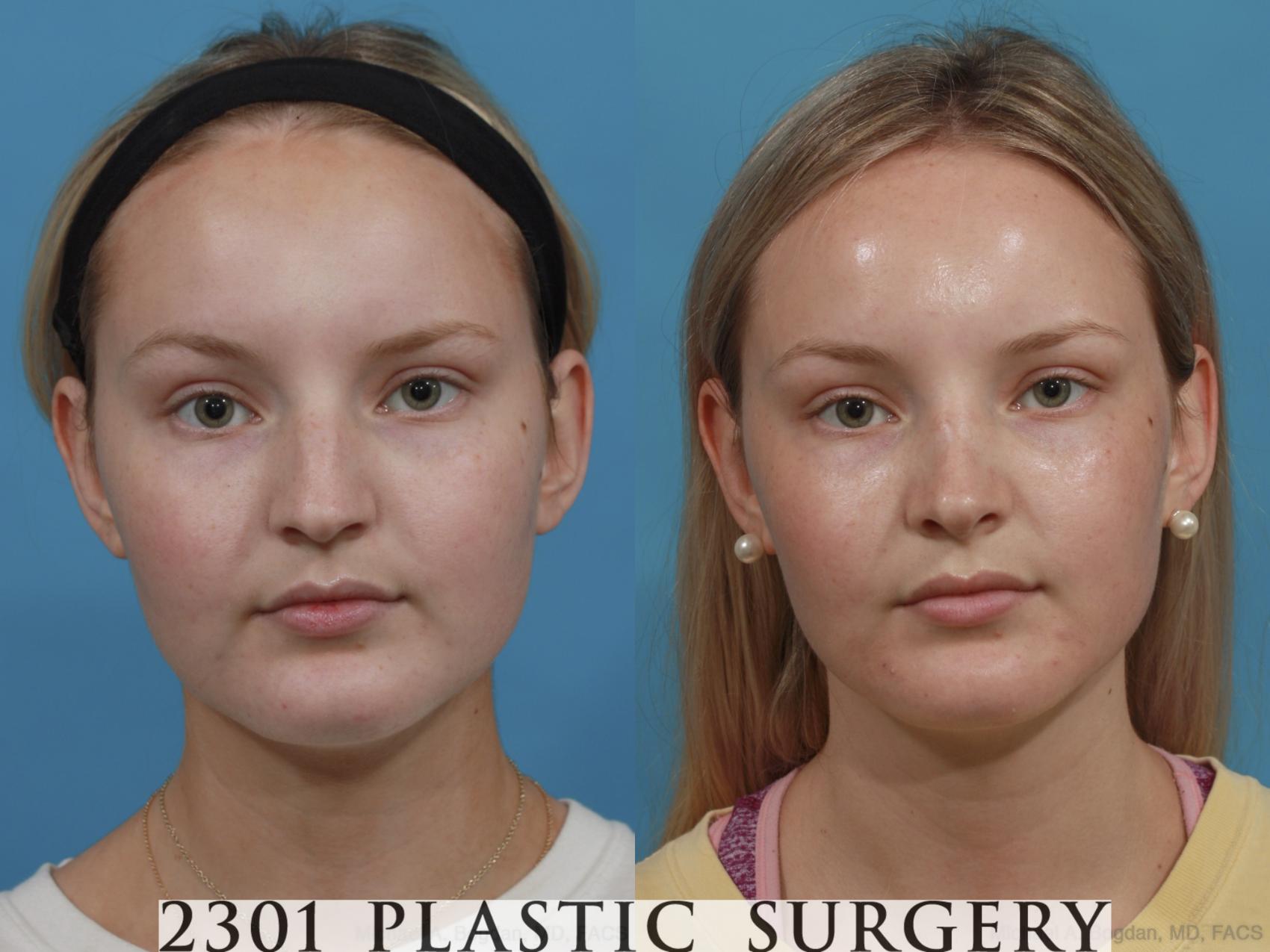 Before & After Rhinoplasty Case 572 View #1 View in Fort Worth, Plano, & Frisco, Texas