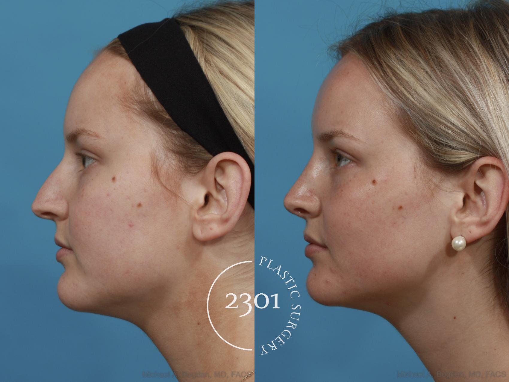 Before & After Rhinoplasty Case 572 View #2 View in Fort Worth, Plano, & Frisco, Texas