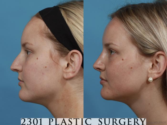 Before & After Rhinoplasty Case 572 View #2 View in Fort Worth, Plano, & Frisco, Texas
