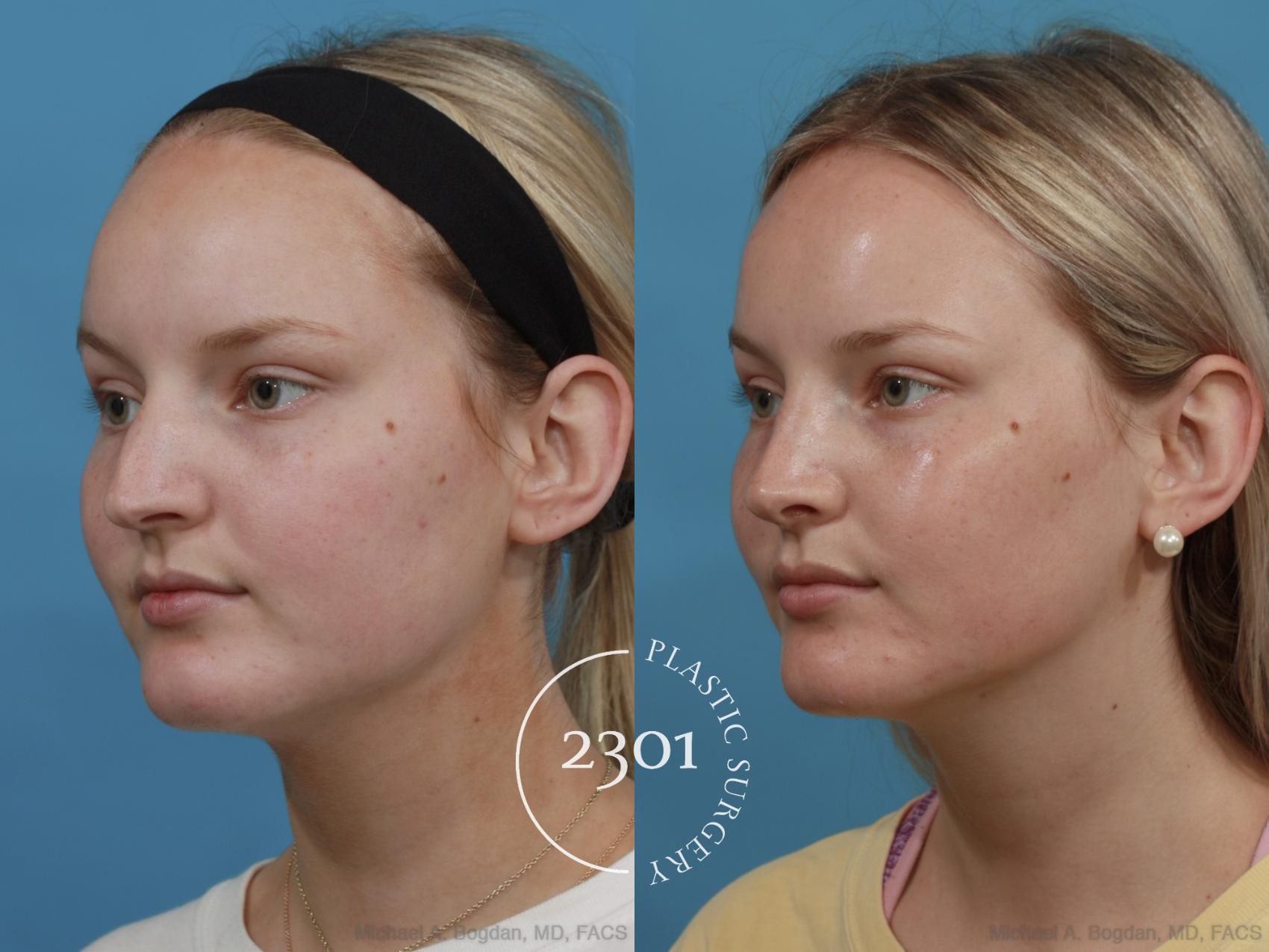 Before & After Rhinoplasty Case 572 View #3 View in Fort Worth, Plano, & Frisco, Texas