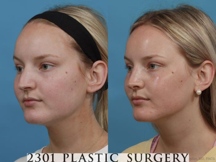 Before & After Rhinoplasty Case 572 View #3 View in Fort Worth, Plano, & Frisco, Texas