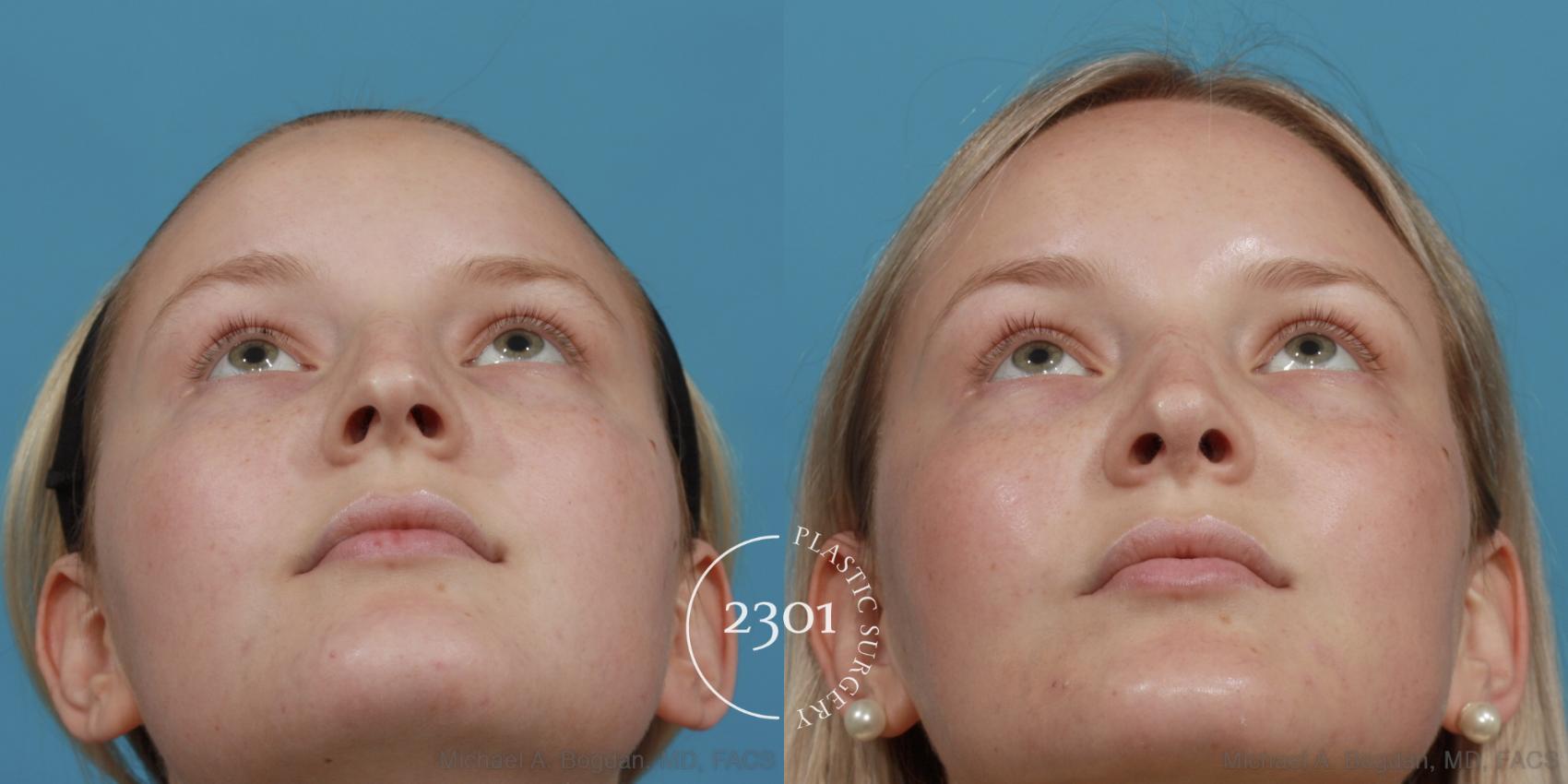 Before & After Rhinoplasty Case 572 View #4 View in Fort Worth, Plano, & Frisco, Texas