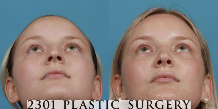 Before & After Rhinoplasty Case 572 View #4 View in Fort Worth, Plano, & Frisco, Texas