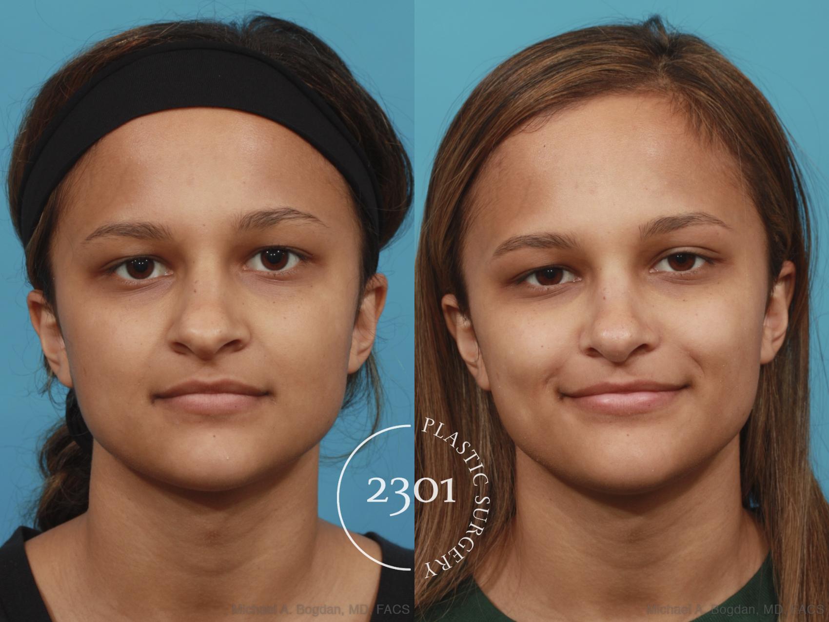 Before & After Rhinoplasty Case 573 View #1 View in Fort Worth, Plano, & Frisco, Texas