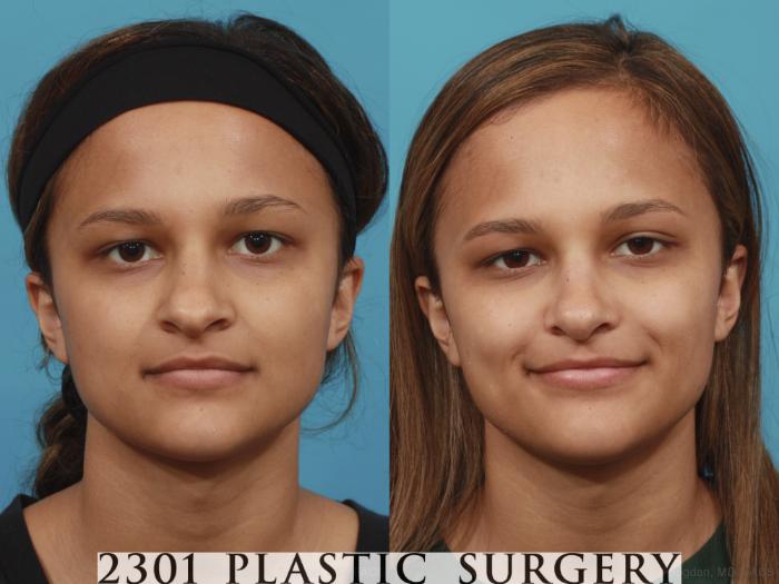 Before & After Rhinoplasty Case 573 View #1 View in Fort Worth, Plano, & Frisco, Texas