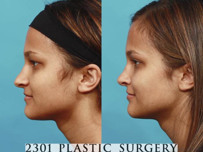 Before & After Rhinoplasty Case 573 View #2 View in Fort Worth, Plano, & Frisco, Texas