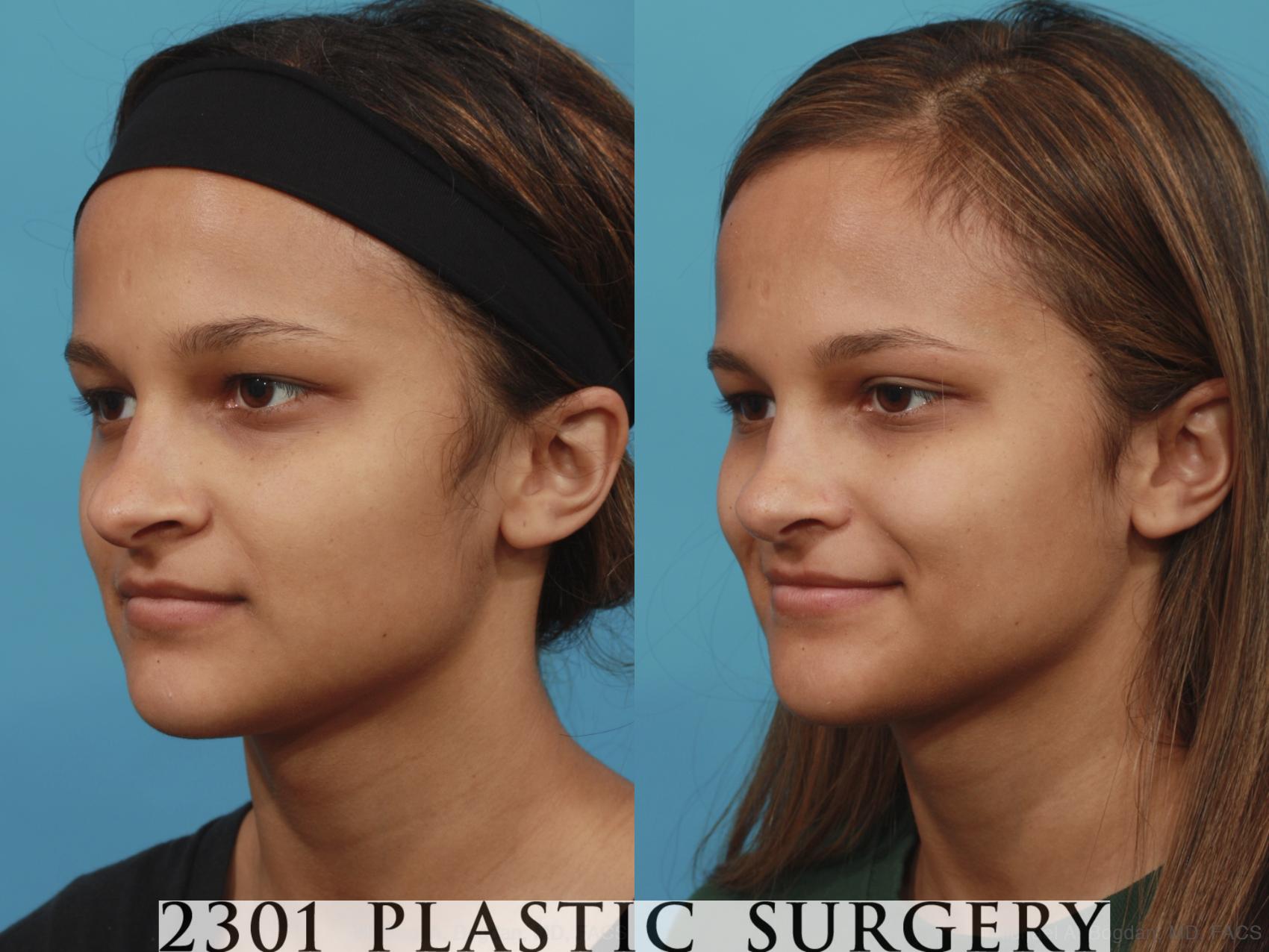 Before & After Rhinoplasty Case 573 View #3 View in Fort Worth & Frisco, Texas