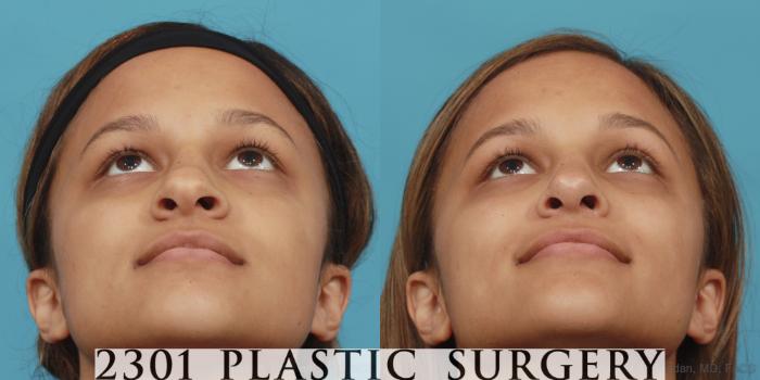 Before & After Rhinoplasty Case 573 View #4 View in Fort Worth, Plano, & Frisco, Texas