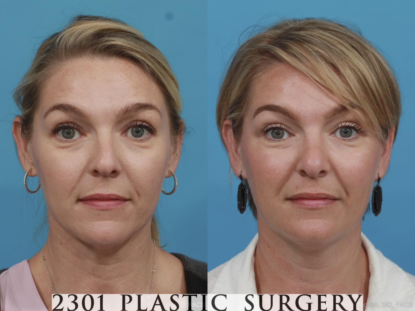 Before & After Rhinoplasty Case 574 View #1 View in Fort Worth, Plano, & Frisco, Texas