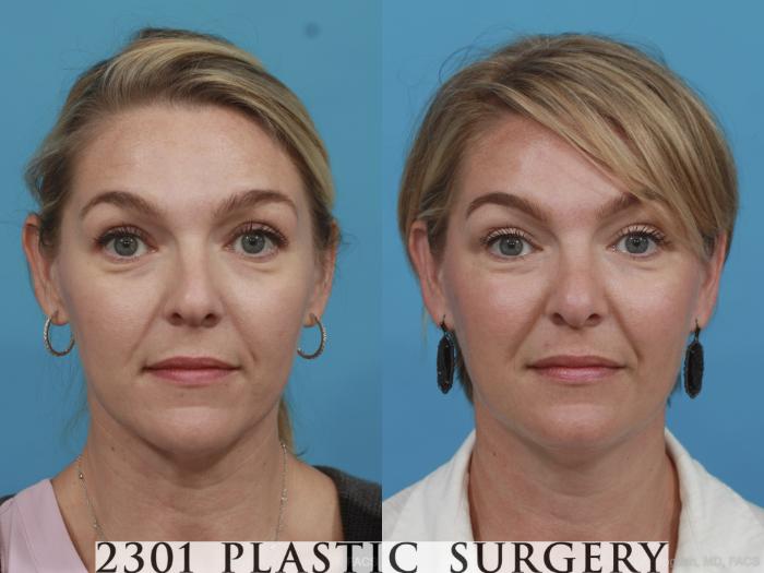 Before & After Rhinoplasty Case 574 View #1 View in Fort Worth & Frisco, Texas
