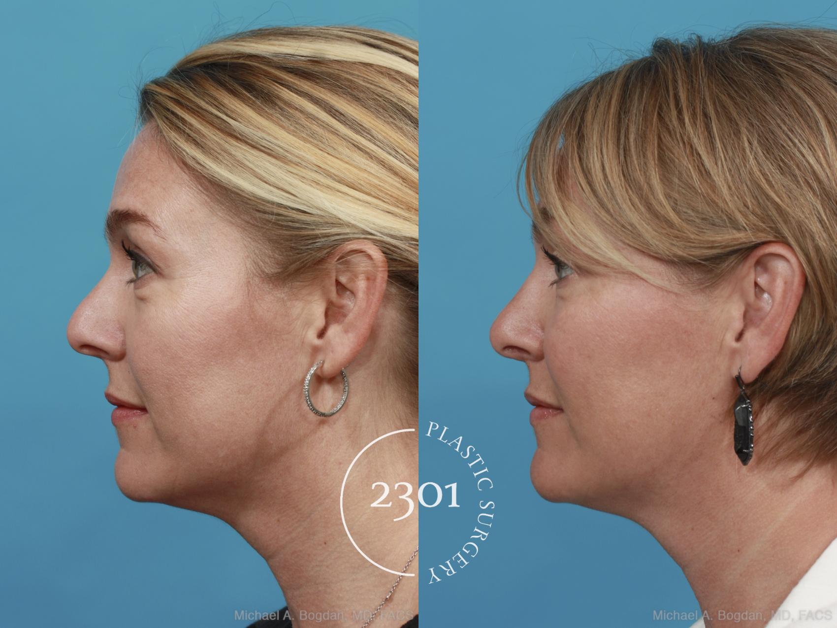 Before & After Rhinoplasty Case 574 View #2 View in Fort Worth, Plano, & Frisco, Texas