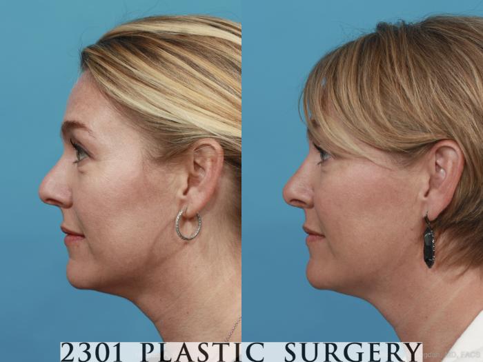 Before & After Rhinoplasty Case 574 View #2 View in Fort Worth, Plano, & Frisco, Texas