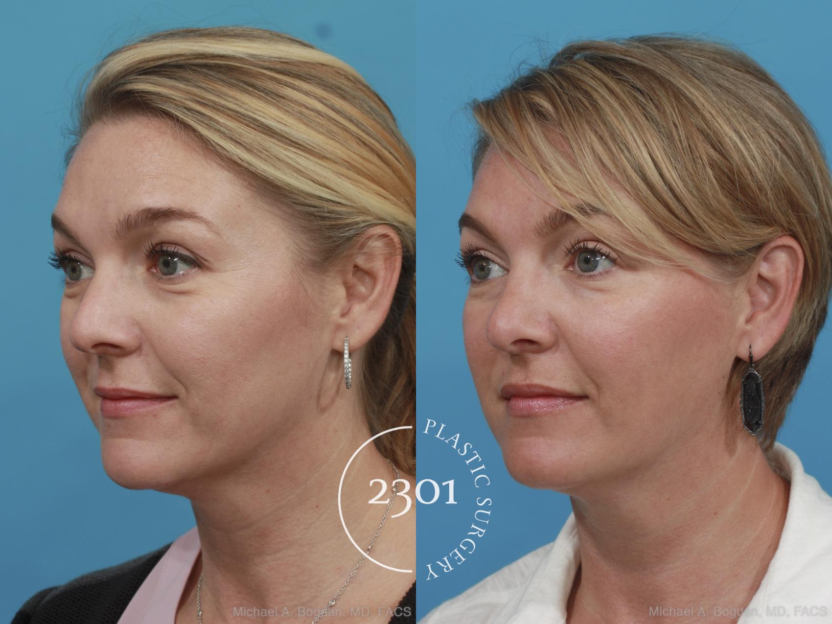 Before & After Rhinoplasty Case 574 View #3 View in Fort Worth, Plano, & Frisco, Texas