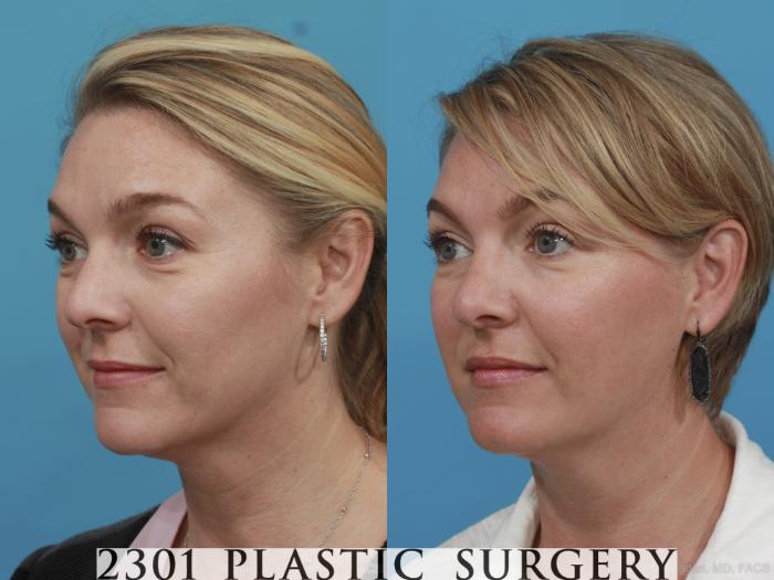 Before & After Rhinoplasty Case 574 View #3 View in Fort Worth, Plano, & Frisco, Texas