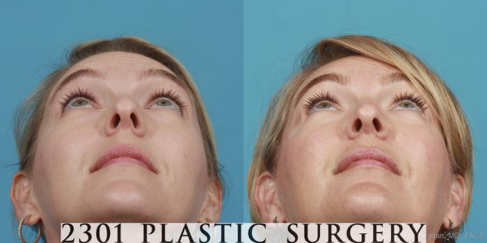 Before & After Rhinoplasty Case 574 View #4 View in Fort Worth, Plano, & Frisco, Texas