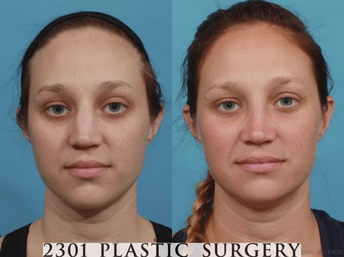Before & After Rhinoplasty Case 585 View #1 View in Fort Worth, Plano, & Frisco, Texas