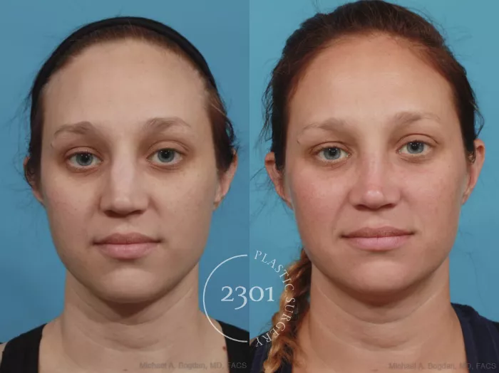 健康・医学 Preservation Rhinoplasty 健康・医学 Preservation Rhinoplasty Preservation Rhinoplasty