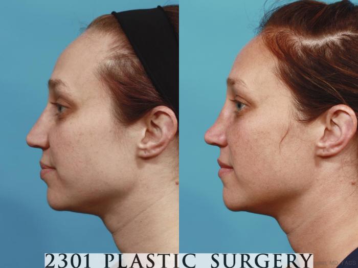 Before & After Rhinoplasty Case 585 View #2 View in Fort Worth, Plano, & Frisco, Texas